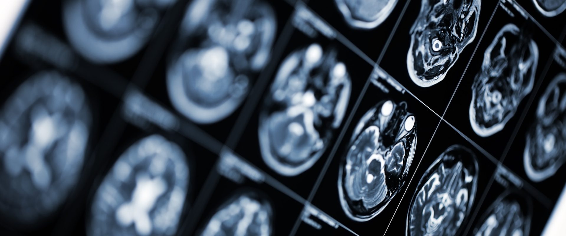 Multiple brain scan images displayed on a screen, showing detailed cross-sections of a brain in black and white.