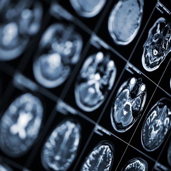 Multiple brain scan images displayed on a screen, showing detailed cross-sections of a brain in black and white.