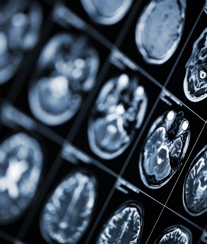 Multiple brain scan images displayed on a screen, showing detailed cross-sections of a brain in black and white.